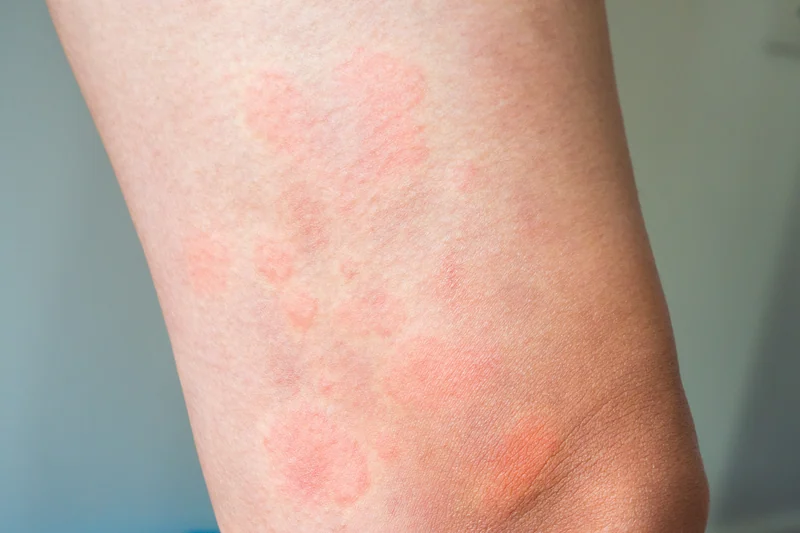 Allergic Skin Diseases