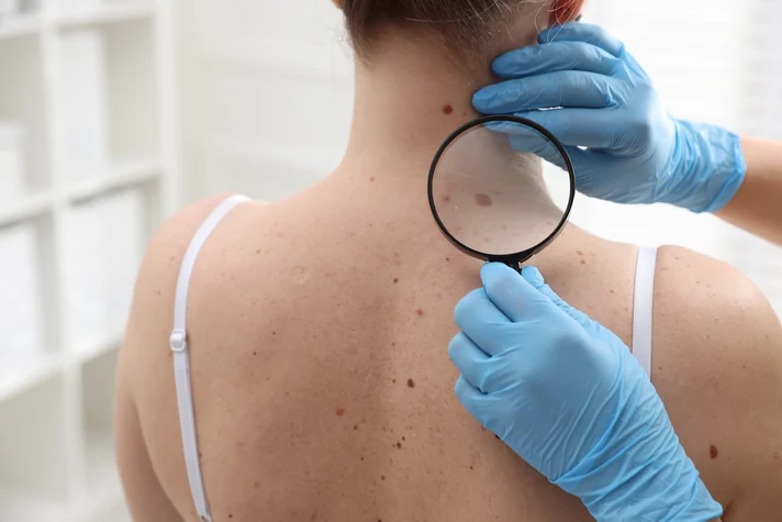 Mole Monitoring and Dermoscopy