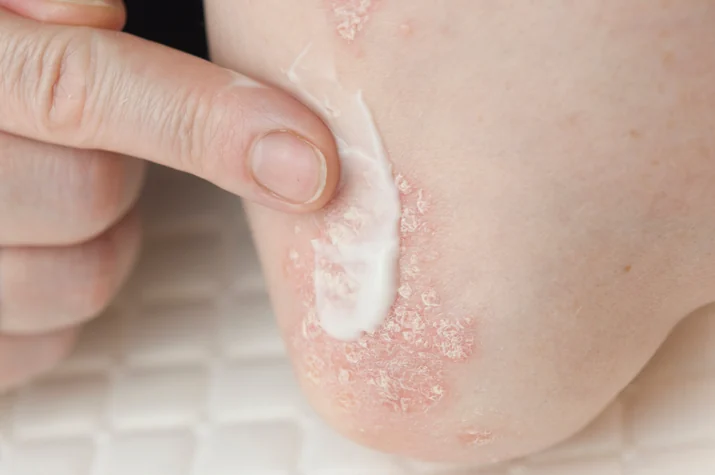 Psoriasis