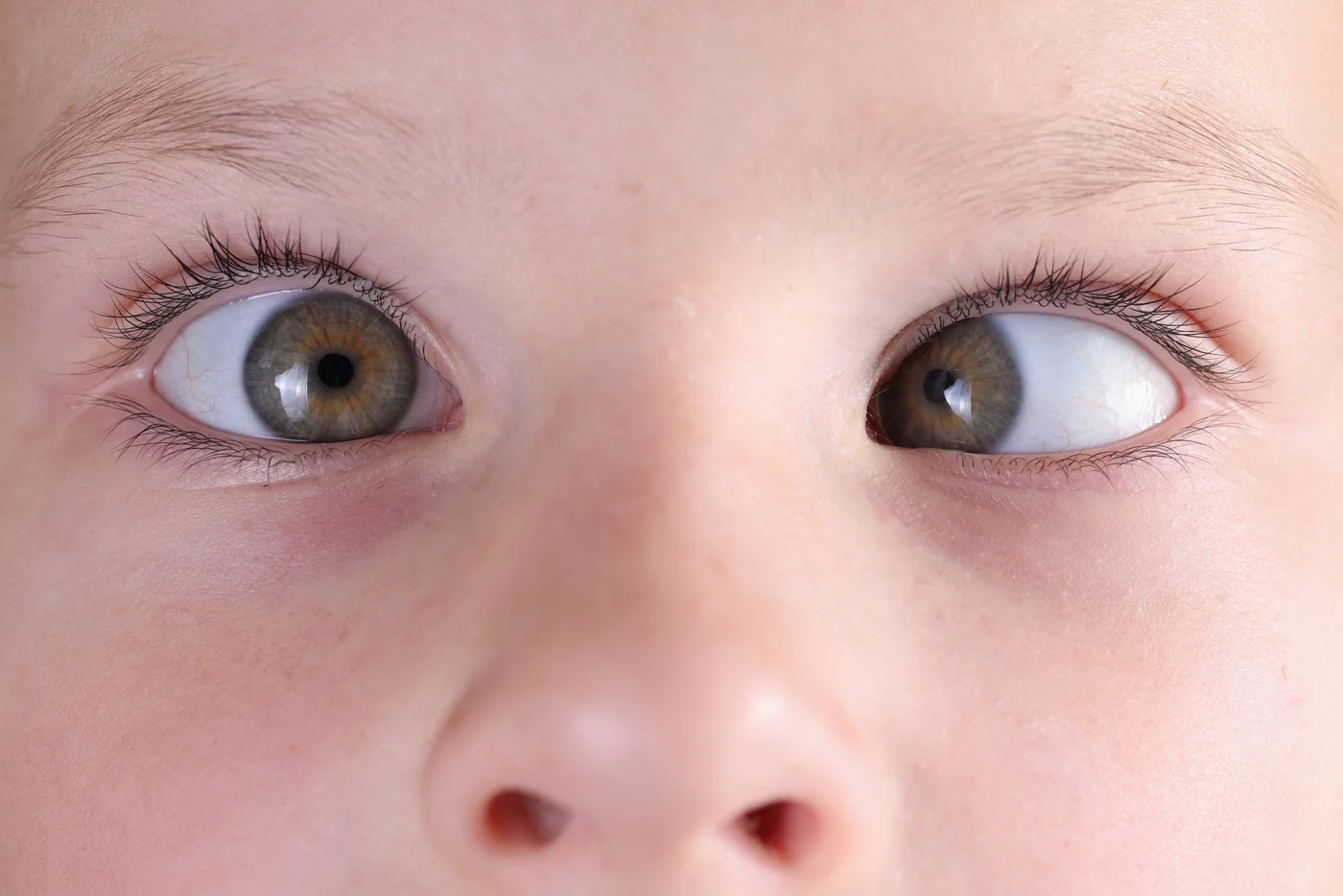 Strabismus