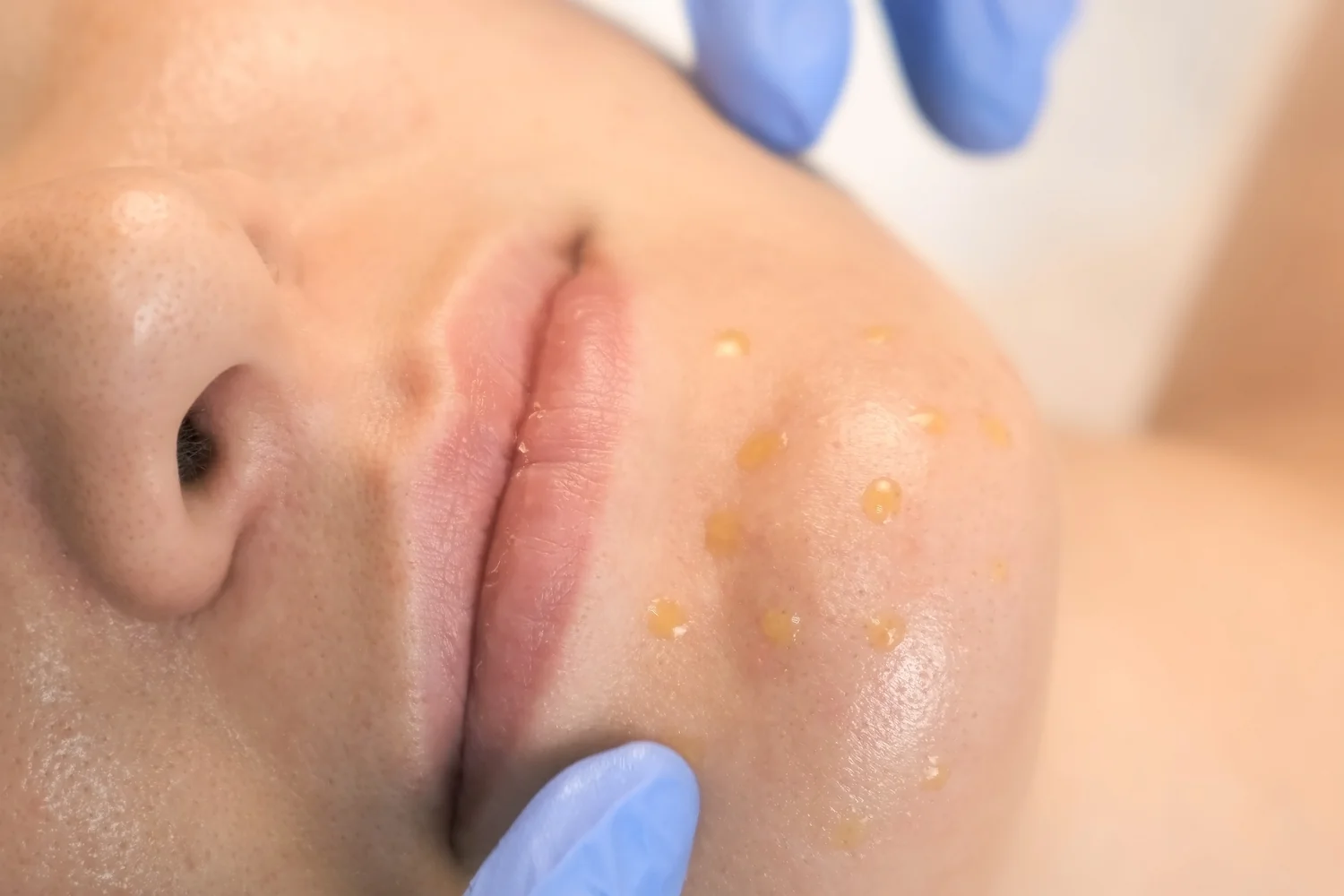 A senior woman undergoes a cosmetic injection procedure in a medical facility.