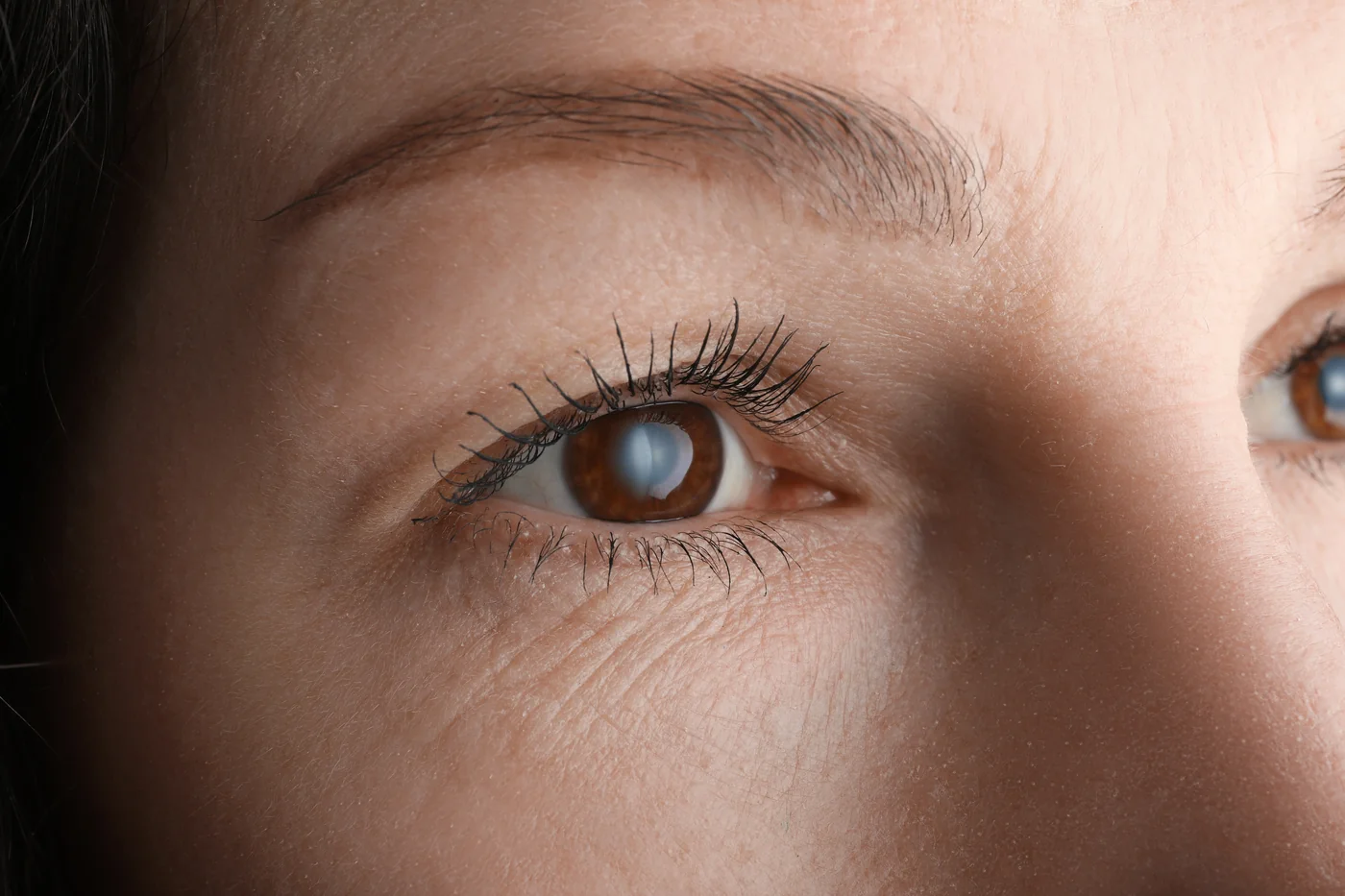Cataract