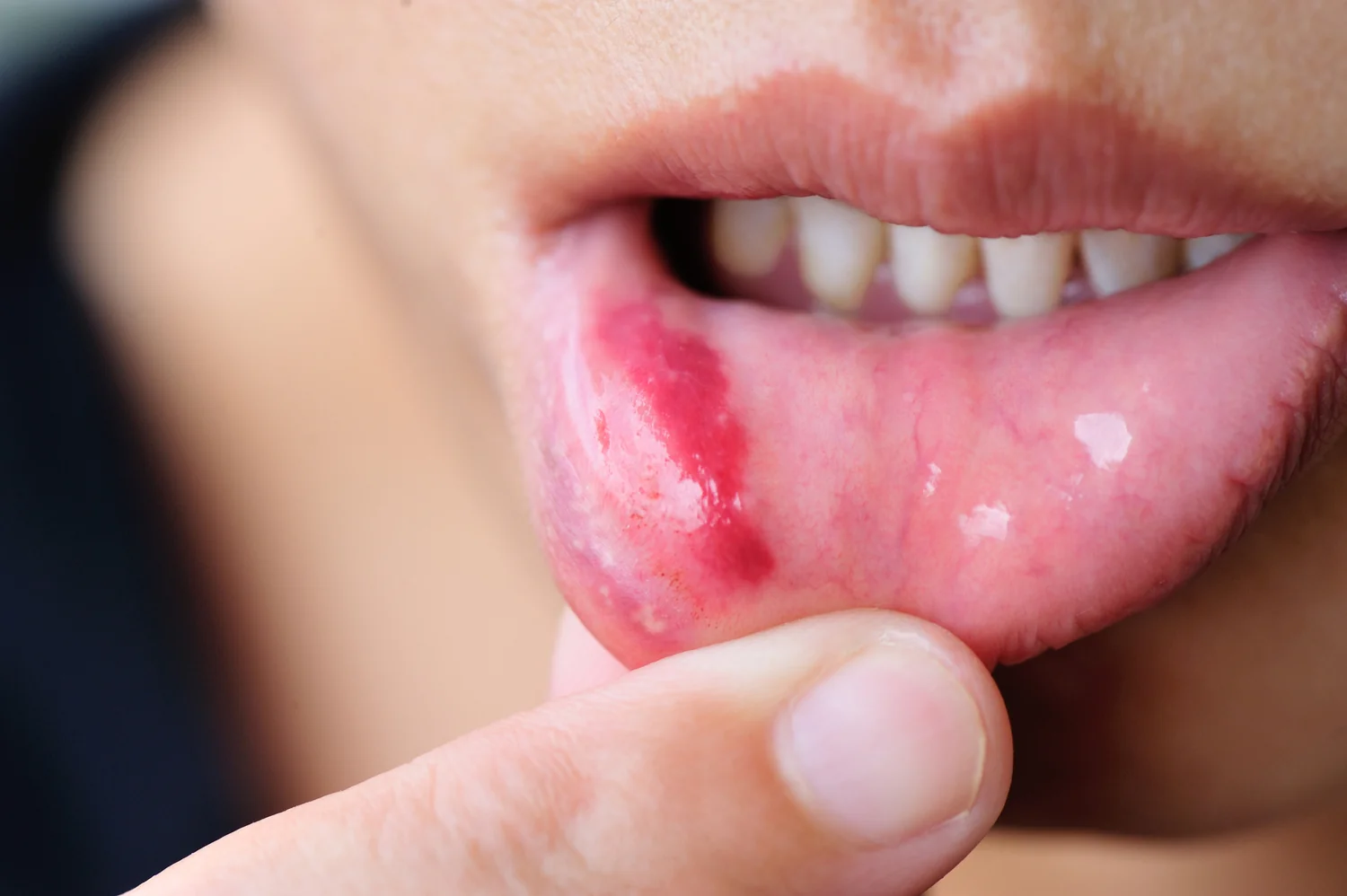 Behçet's Disease